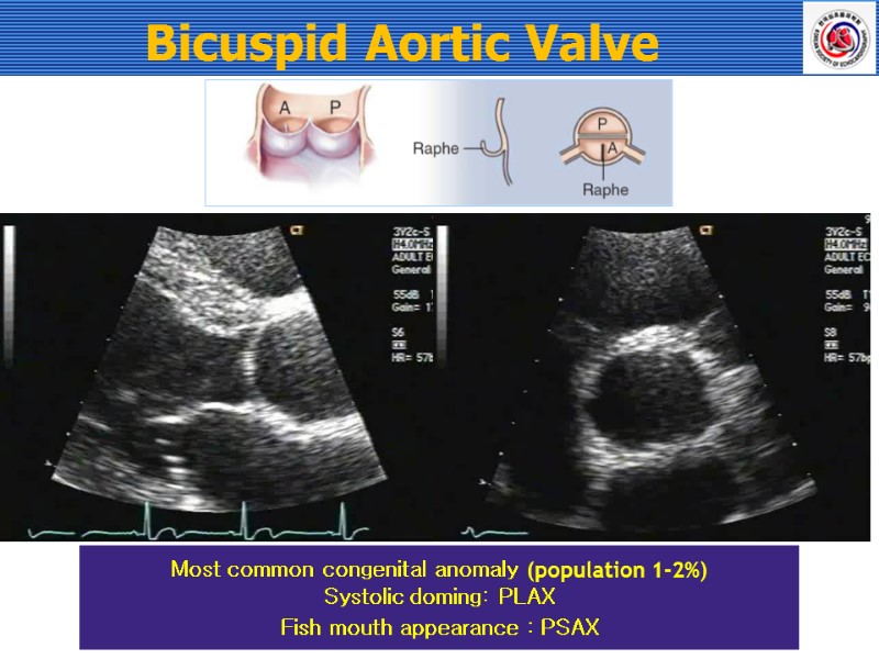 Bicuspid Aortic Valve Most common congenital anomaly (population 1-2%) Systolic doming: PLAX Fish mouth